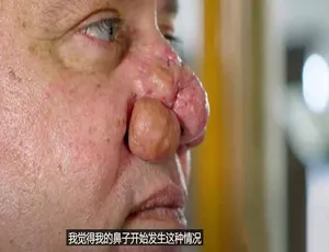 肿瘤医生纪录片 第一季 1080P高清 中文字幕-蓝海网