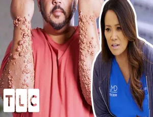 挤痘大师 Dr Pimple Popper 第九季全10集 高清中字解说 纪录片完整版